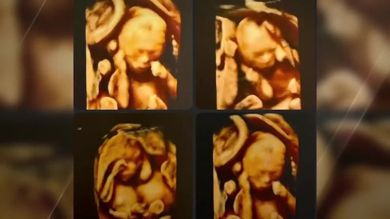 The four baby girls were safely delivered by C-section at 28 weeks, each weighing about 2.2...